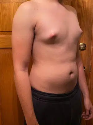 Xsculpt, Gynecomastia Grade I<br>Case# 248