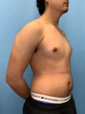 Xsculpt, Gynecomastia Grade I<br>Case# 248