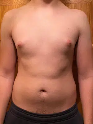 Xsculpt, Gynecomastia Grade I<br>Case# 248