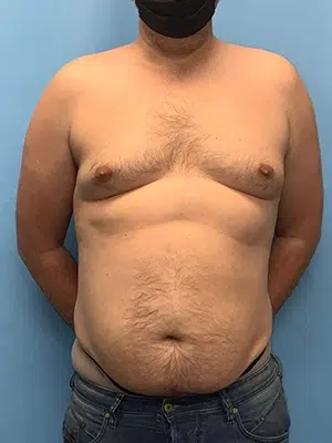Xsculpt Male Surgery