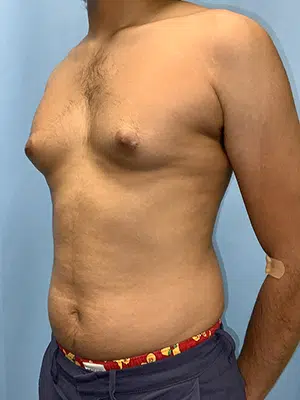 Xsculpt, Gynecomastia Grade I <br>Case# 700