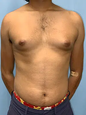 Xsculpt, Gynecomastia Grade I <br>Case# 700