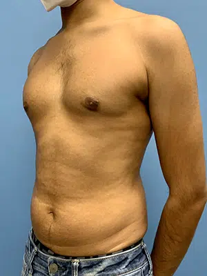 Xsculpt, Gynecomastia Grade I <br>Case# 700