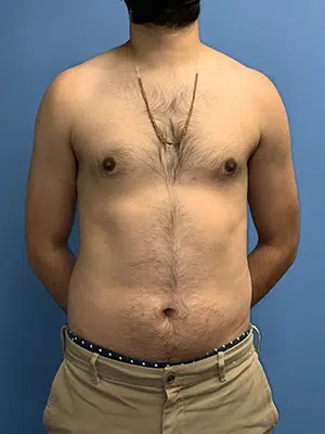 Xsculpt Male Surgery
