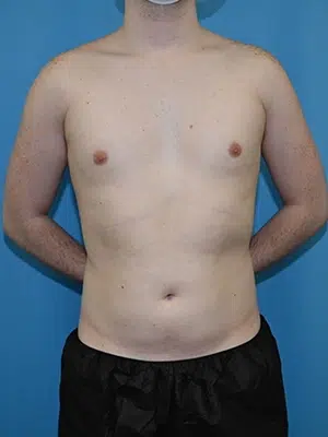 Xsculpt, Liposuction360 Case# 244