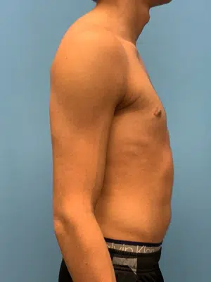 Xsculpt, Gynecomastia Grade I<br>Case# 257