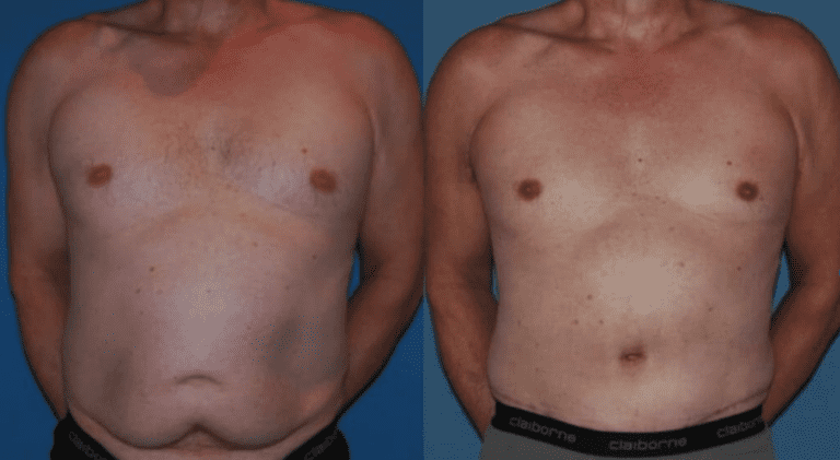 Male Tummy Tuck Recovery 2 Male tummy tuck