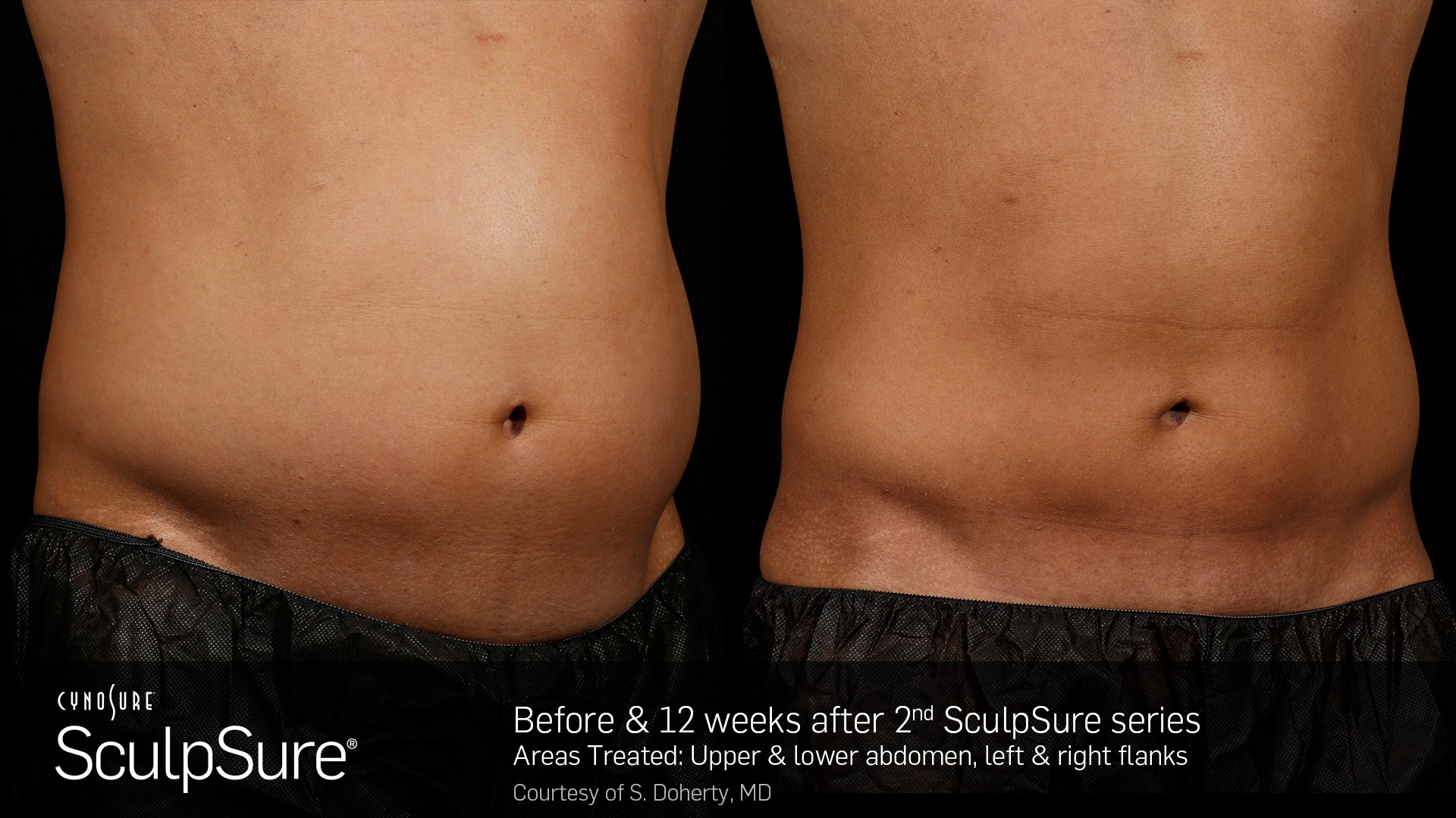 does sculpsure work