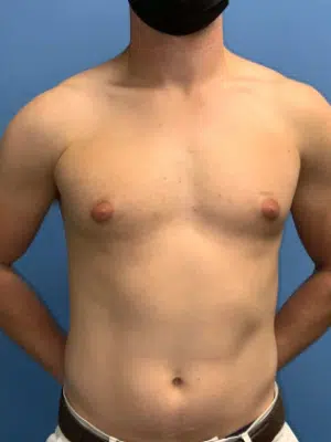 Xsculpt, Gynecomastia Grade I <br>Case# 266