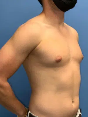 Xsculpt, Gynecomastia Grade I <br>Case# 266