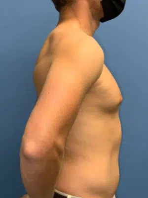 Xsculpt, Gynecomastia Grade I <br>Case# 266