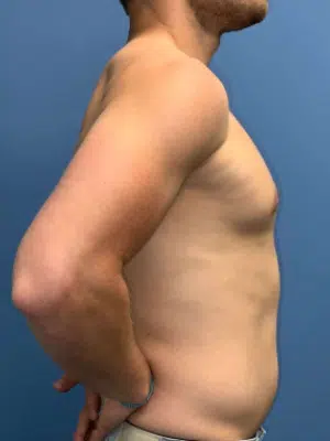 Xsculpt, Gynecomastia Grade I <br>Case# 266