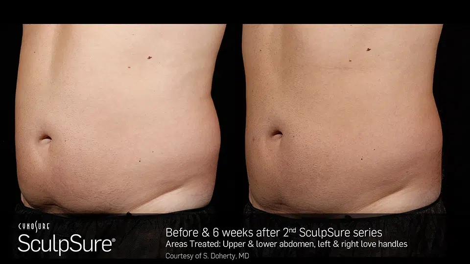 Tummy tuck - before and after Sculpsure treatment.