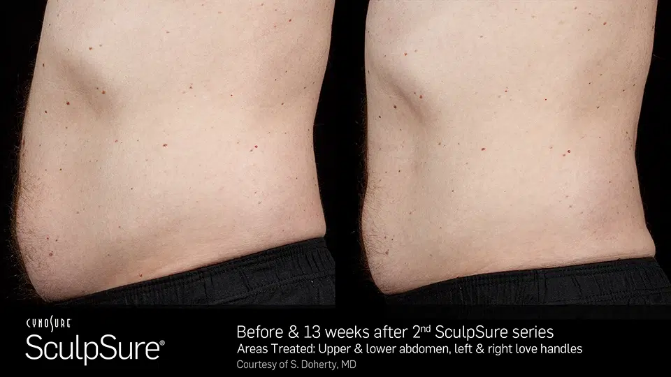 Tummy tuck before and after using Sculpsure.