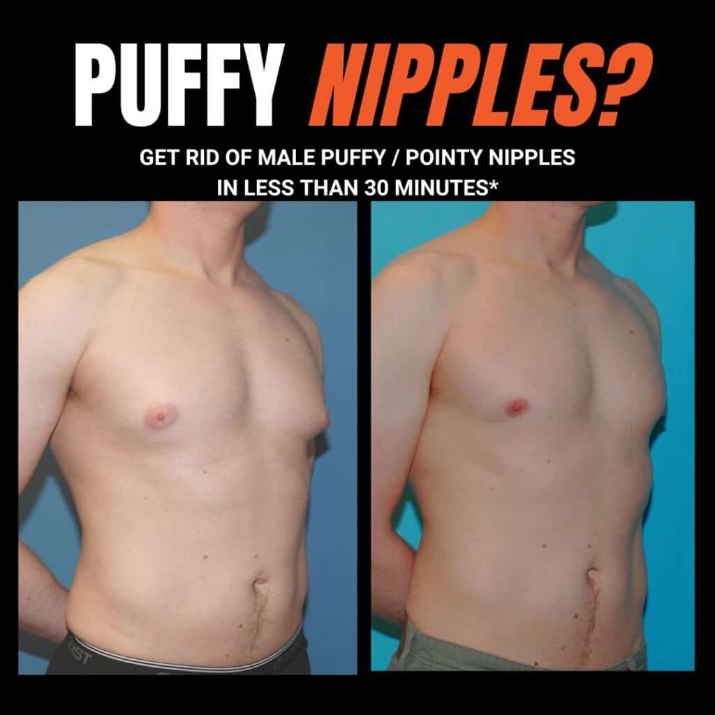 Transformation: Pre and post puffy nipple alteration.