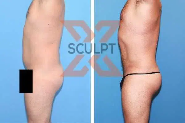 A male undergoes a tummy tuck, experiencing transformations in his appearance.