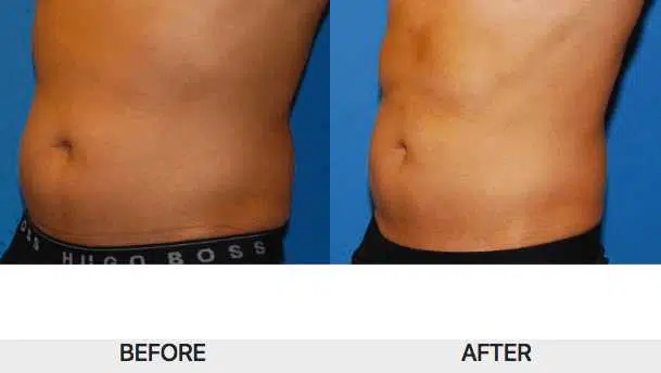 A man's stomach transformation achieved with Sculpsure liposuction.