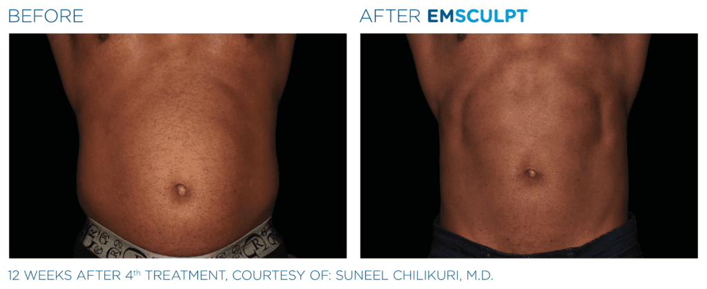 Before and after EmSculpt body sculpting for tummy tuck treatment.