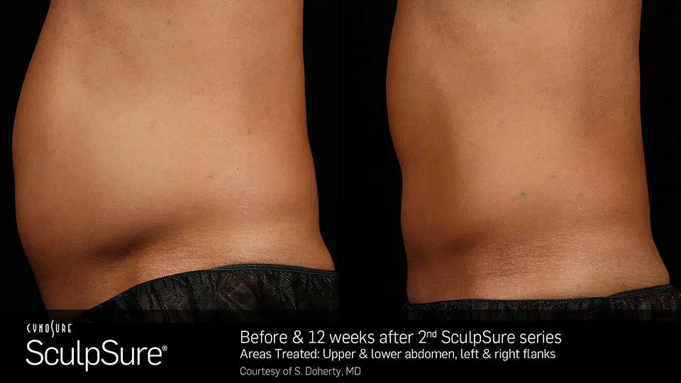 Before and after Sculpsure treatment photos of a patient's thigh.
