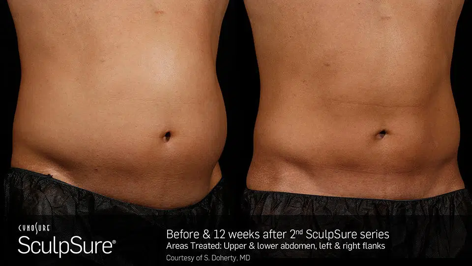 sculpsure before and after photo