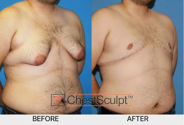 male mastectomy before and after grade 4 gynecomastia by Dr. Anh-Tuan Truong XSCULPT