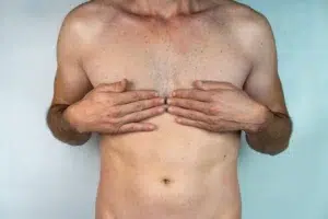 gynecomastia copia
