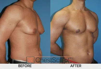 gynecomastia before and after photo - xsculpt cosmetic surgery for men
