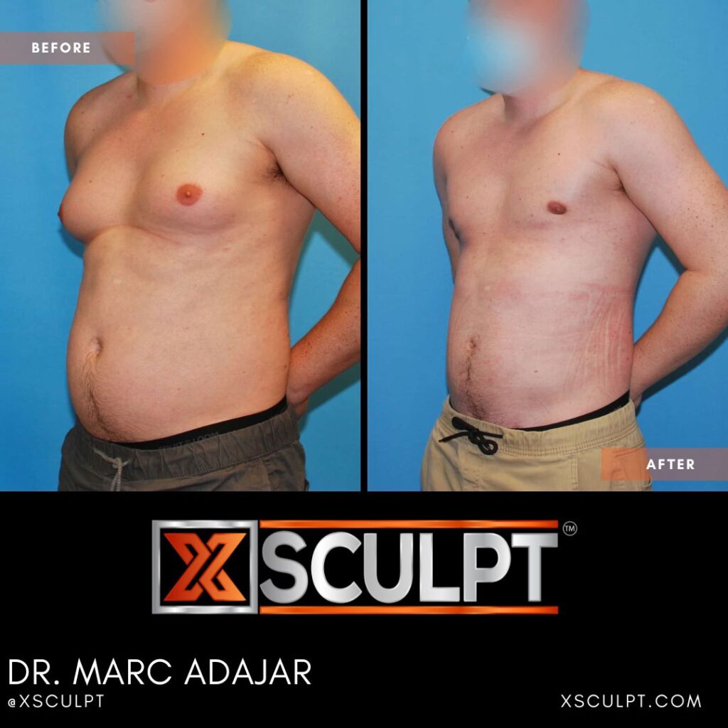 how much does grade 3 gynecomastia cost xsculpt 5