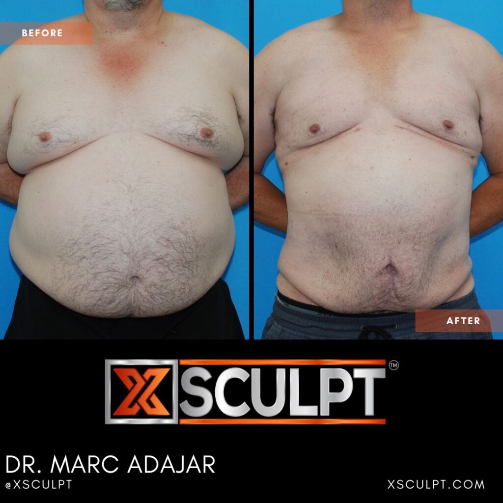 how much does grade 3 gynecomastia cost xsculpt 6