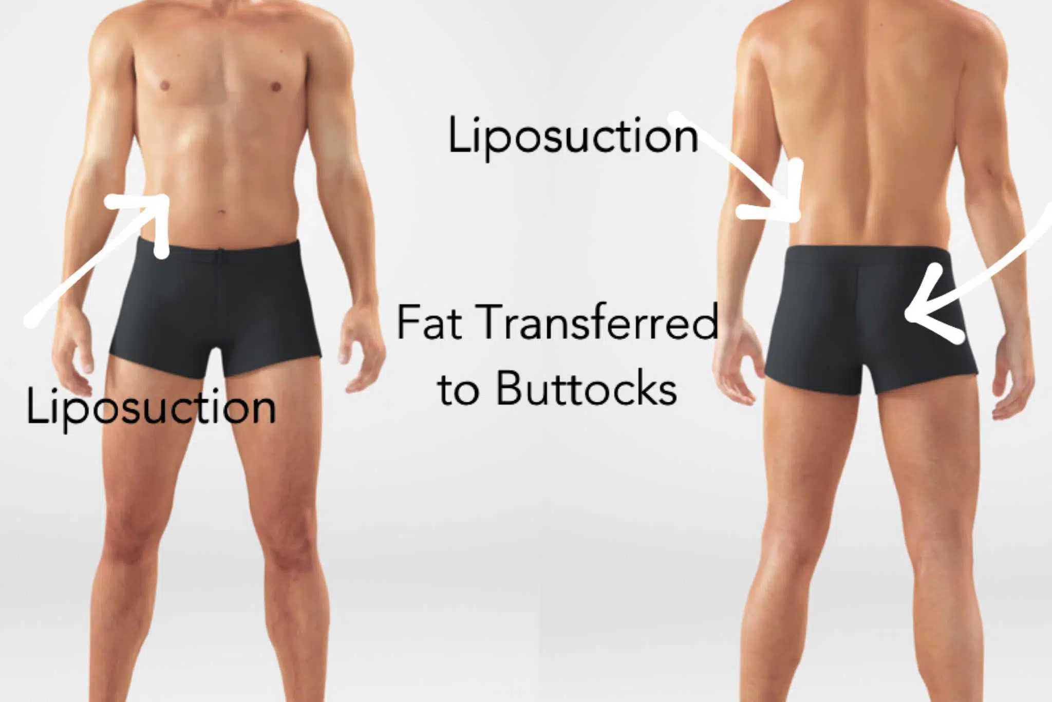 Male BBL using fat transfer to buttocks.