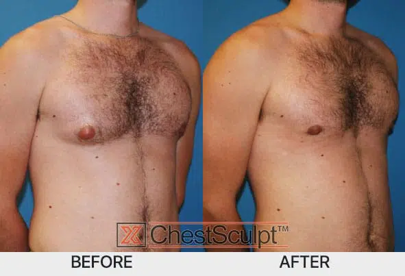 Before and after following ChestSculpt™ gynecomastia surgery by Dr. Marc Adajar, Chicago Illinois. Results may vary from patient to patient.