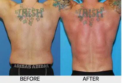 The back of a man undergoes a transformation before and after LIPOSUCTION 360 treatment.