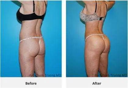 A woman's buttocks transformation with liposuction.