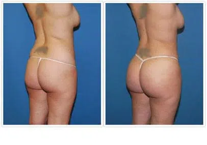 A woman's butt before and after tummy tuck, focusing specifically on the change in appearance.