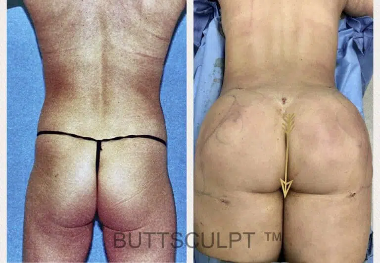 Buttlift before and after for male patients with Puffy Nipple Syndrome.