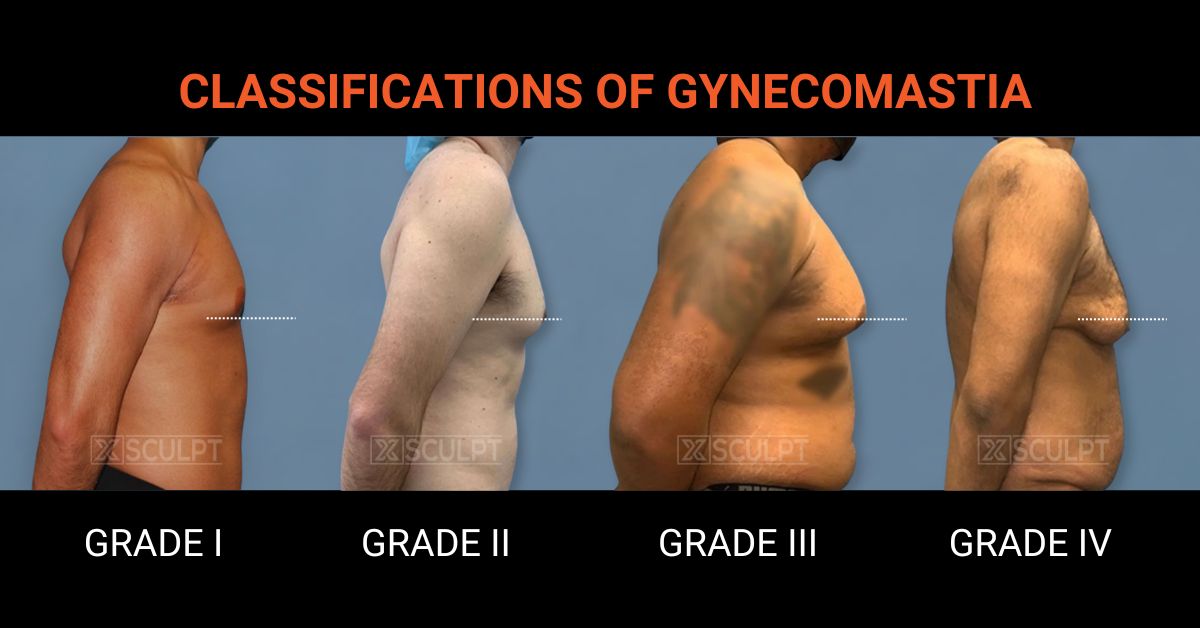 Gynecomastia grades - How to know if you have gynecomastia