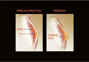 A diagram illustrating the distinction between a male breast and gynecomastia, addressing TRT for men.