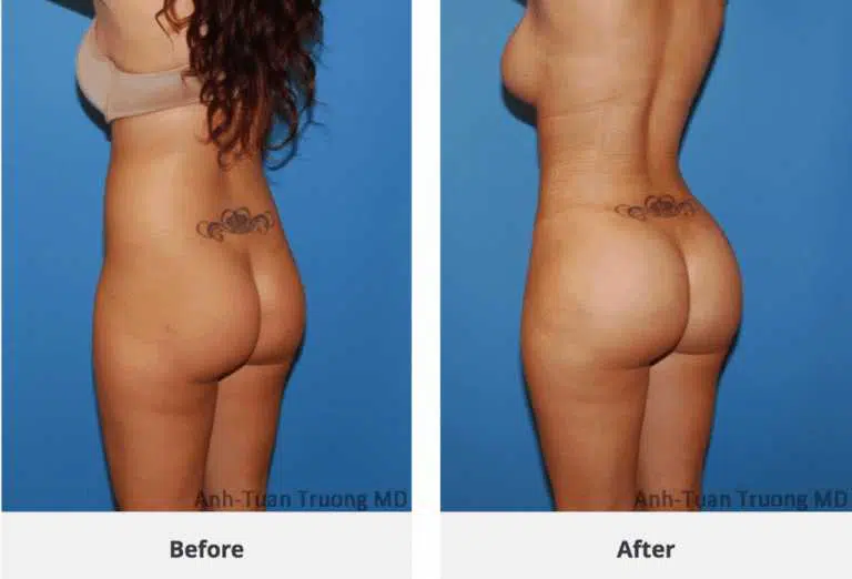 A woman's tummy tuck surgery results in a transformed and toned posterior.