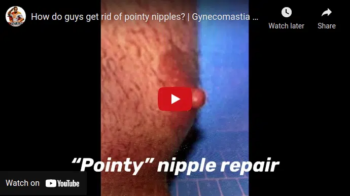 How can a Brazilian Butt Lift help in achieving pointy nipple repair?