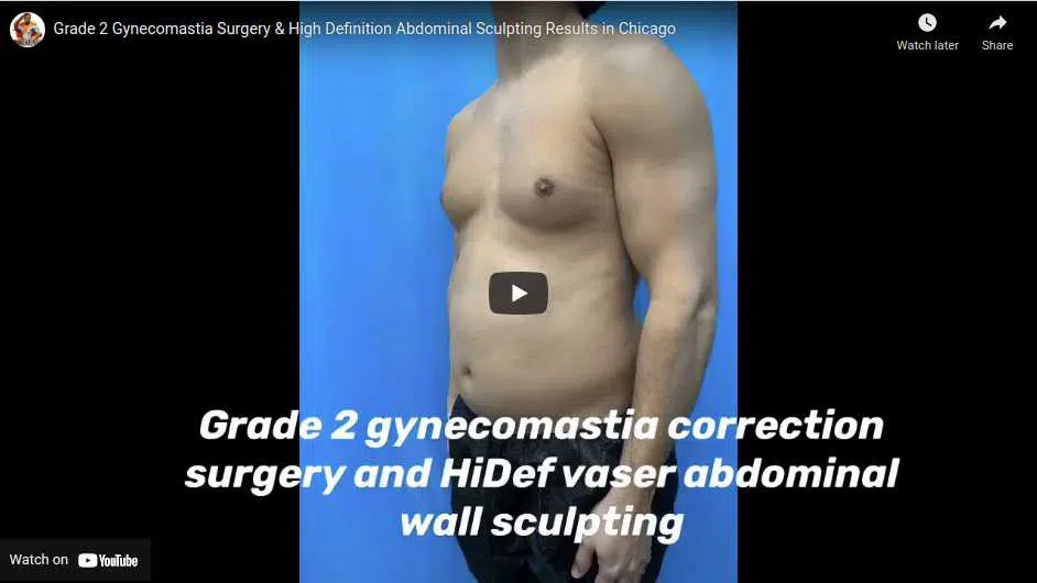 Grade 2 symtomatic correction and hdf tummy tuck surgery with abdominal etching.