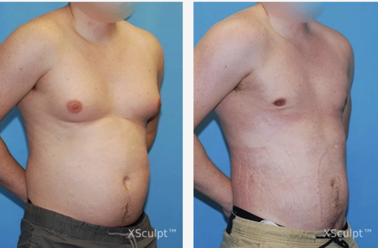 Gynecomastia Surgery in Chicago 8 what-is-gynecomastia-xsculpt-chicago