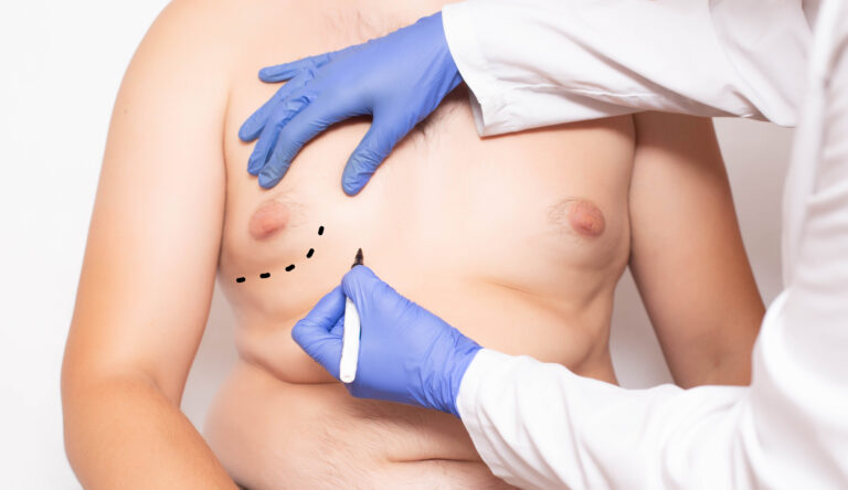 Gynecomastia Surgery Recovery: What To Expect 8 A man is receiving a chest x-ray during gynecomastia surgery.