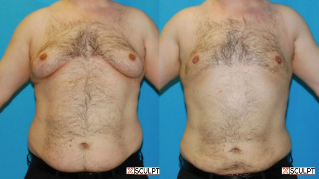 Daddy Do Over: Before and after tummy tuck transformation.