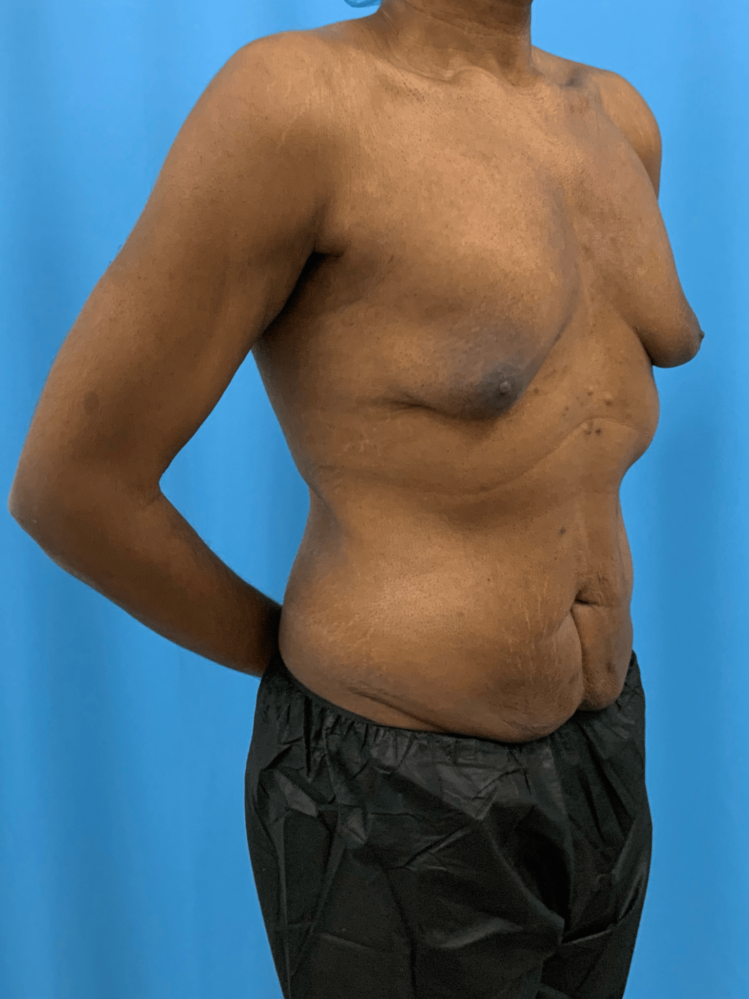 Xsculpt, Gynecomastia Grade IV Case #997