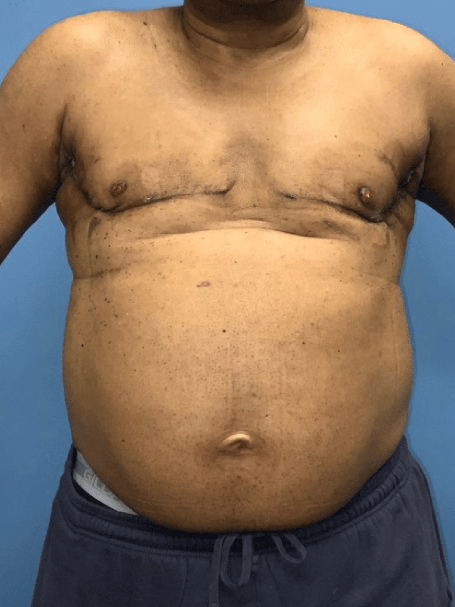 Xsculpt, Gynecomastia Grade IV Case #996