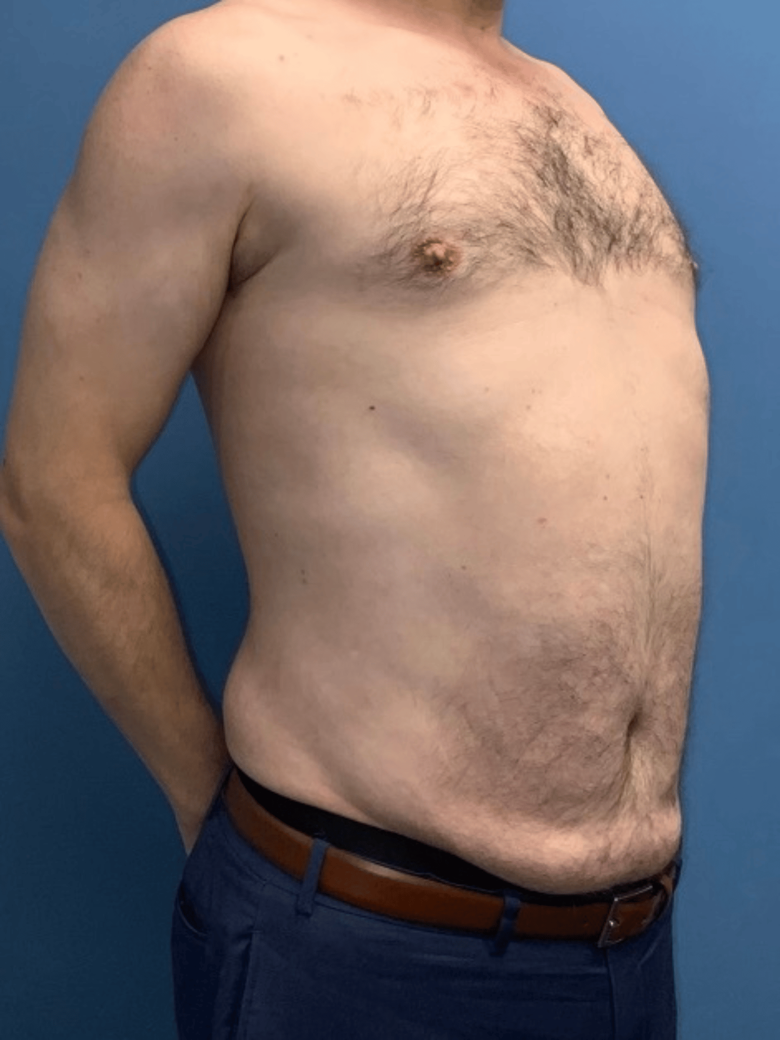 Xsculpt, Gynecomastia Grade II Case #998