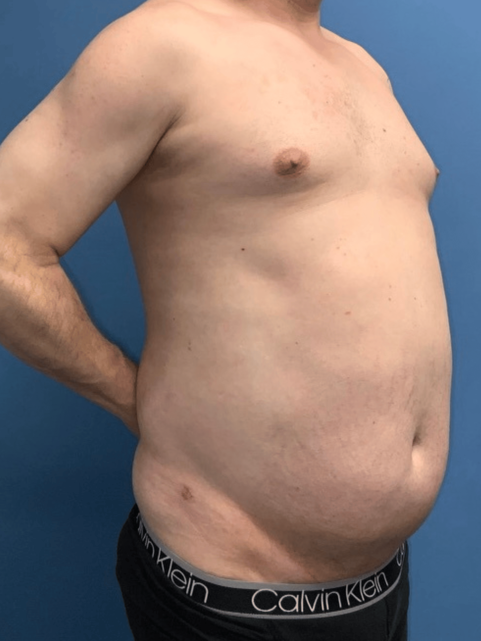 Xsculpt, Gynecomastia Grade II Case #998