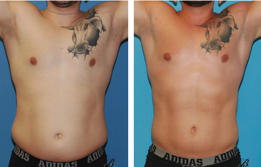 Before and after photos of a tummy tuck with Lipo 360.