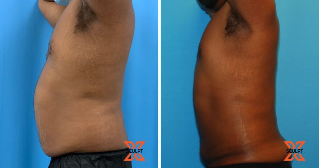 liposuction 360 before after male - xsculpt