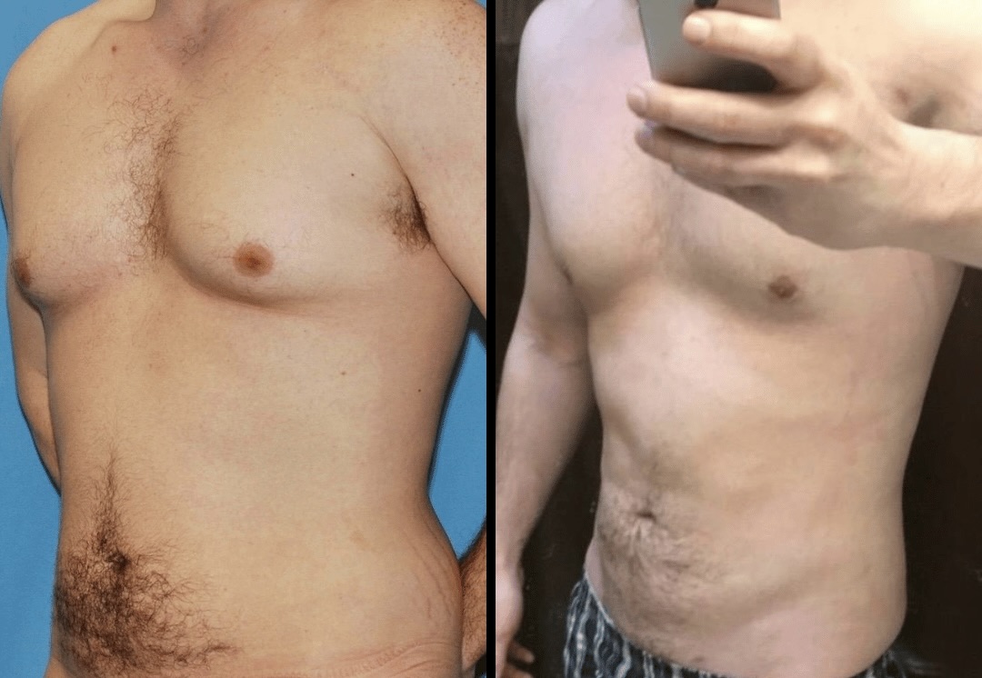 totalsculpt-male-liposuction-surgery-patient-selfie-xsculpt-dr-adajar - pseudogynecomastia surgery